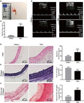 Identification of Transcriptional Variation in Aortic Remodeling Using a Murine Transverse Aortic Constriction (TAC) Model